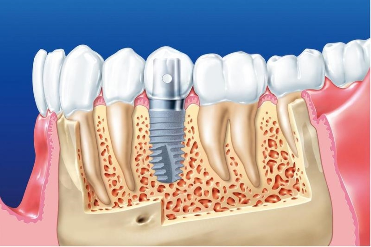 Dành cho ai thắc mắc trồng răng implant có nguy hiểm không
