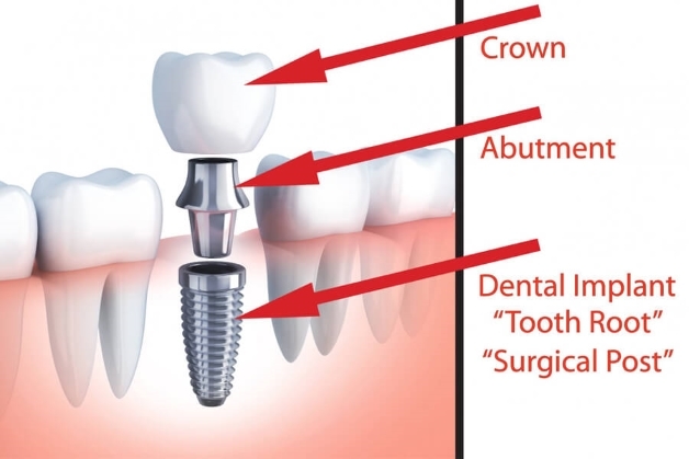 ghép răng implant uy tín