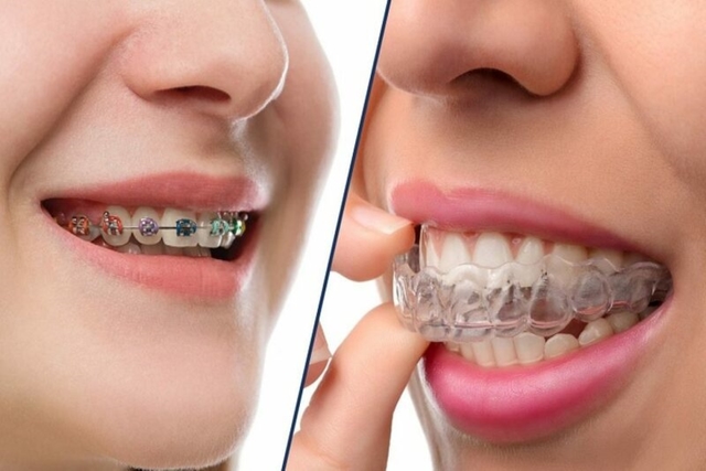 Sự thay đổi trước và sau khi niềng răng hô, răng móm, răng xấu