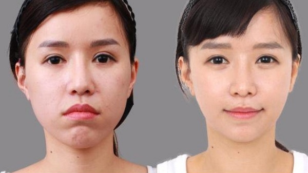 niềng răng hô