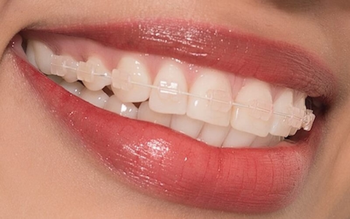 Tư vấn niềng răng: Những điều bệnh nhân cần lưu ý