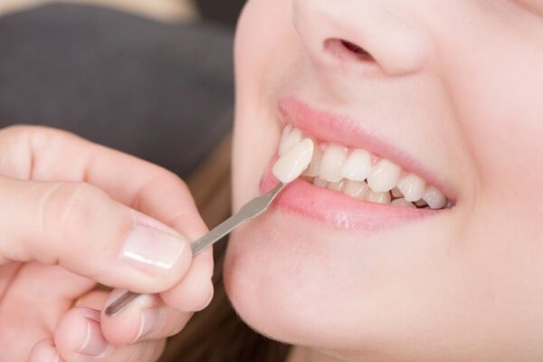 Ưu điểm tuyệt vời của Veneer Emax