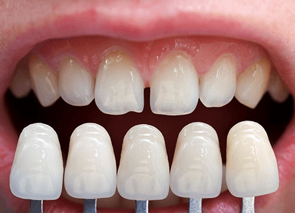 Tìm hiểu về Veneer sứ Emax là gì?