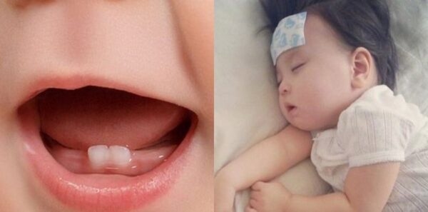 viêm lợi gây sốt có nguy hiểm