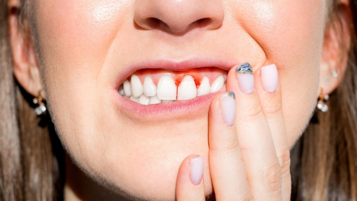 Viêm lợi: Phát sinh do thiếu Vitamin, khoáng chất