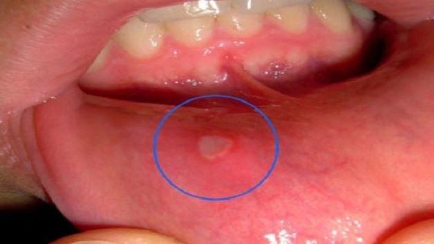 Loét áp tơ miệng là một trong những bệnh viêm lợi cấp hay gặp ở trẻ