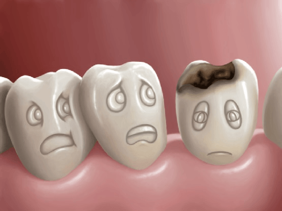 điều trị viêm lợi trong cùng