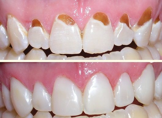 Ý nghĩa hàn răng thẩm mỹ