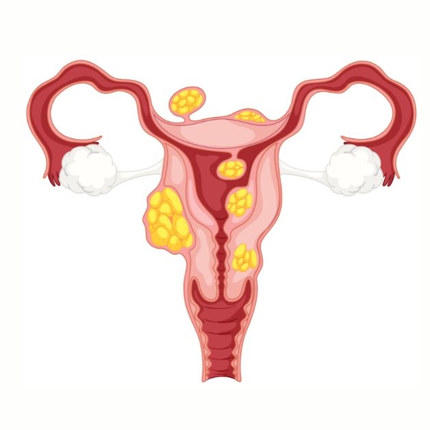 U xơ tử cung có 4 loại chính, đều có khả năng phát triển và chèn ép lên các cơ quan xung quanh 