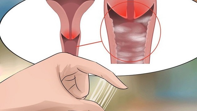 bệnh viêm âm đạo