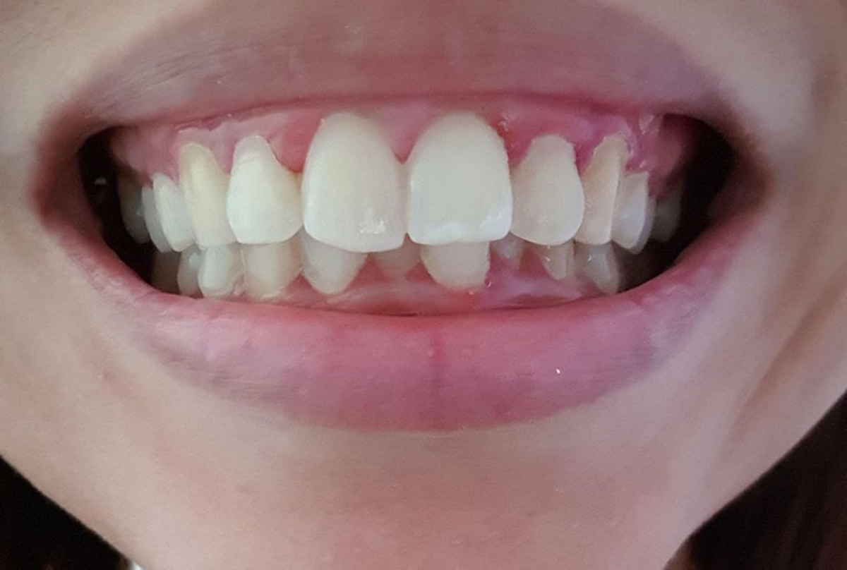 Những điều cần biết về bọc răng sứ 2 răng cửa bị hô