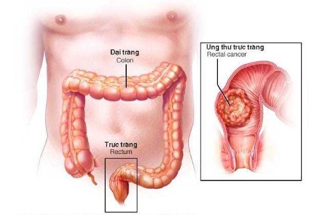 bệnh ung thư trực tràng