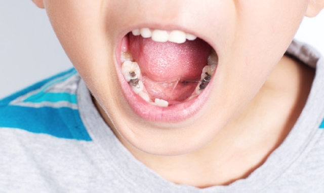 Cách chữa sâu răng cho trẻ 4 tuổi