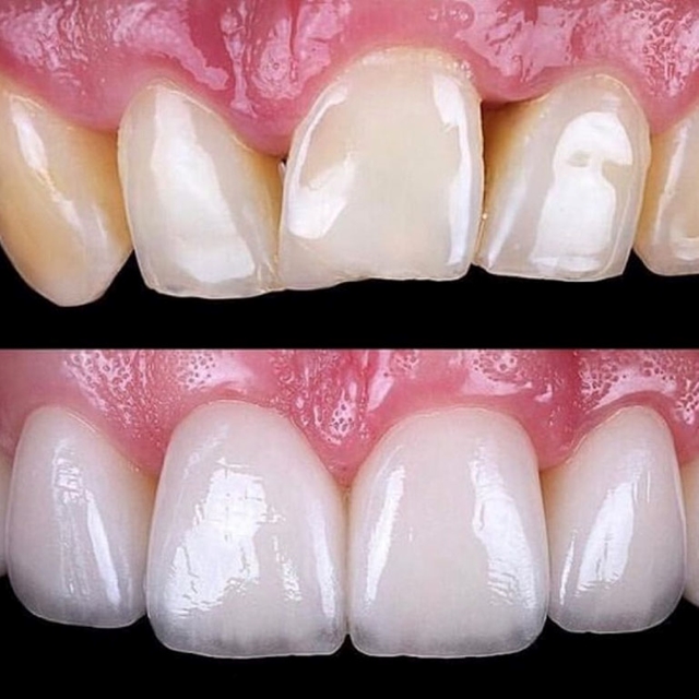 Dán sứ Veneer Emax giá bao nhiêu và ưu điểm