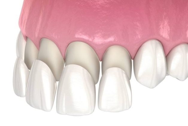 Hiệu quả dán Veneer răng