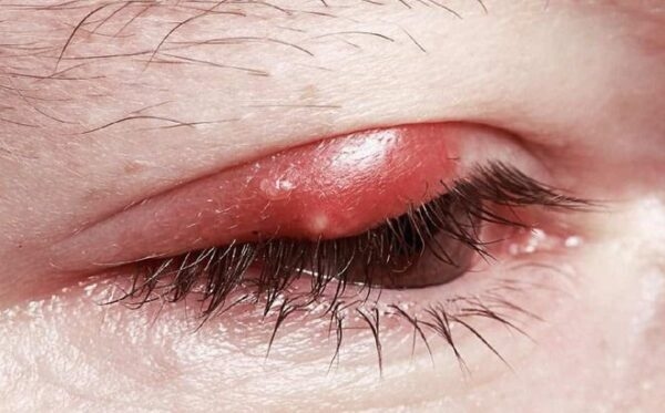Đau mí mắt trên do bị lẹo