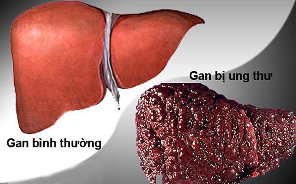 Những dấu hiệu cảnh báo khả năng gan bị ung thư