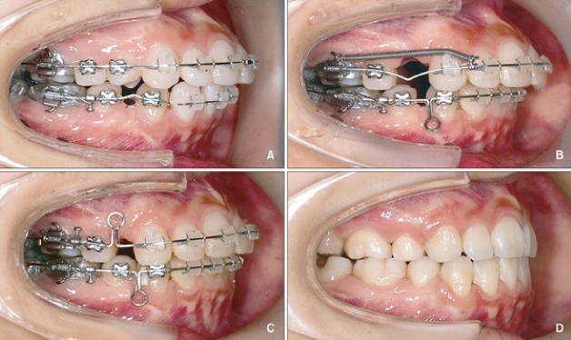 Các giai đoạn niềng răng