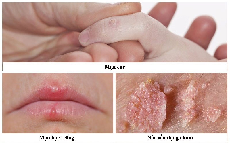 Sùi mào gà (mụn có sinh dục) gây ra do virus HPV ở người