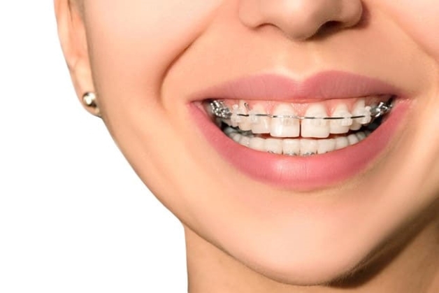 Hiệu quả nẹp răng cửa