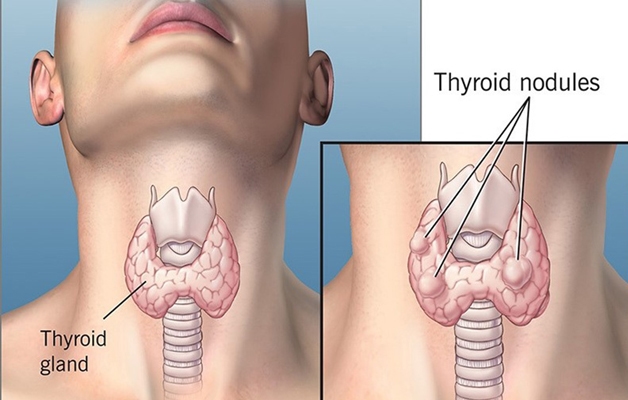Tỷ lệ mắc nhân tuyến giáp ở phụ nữ cao gấp 7 lần so với nam giới.