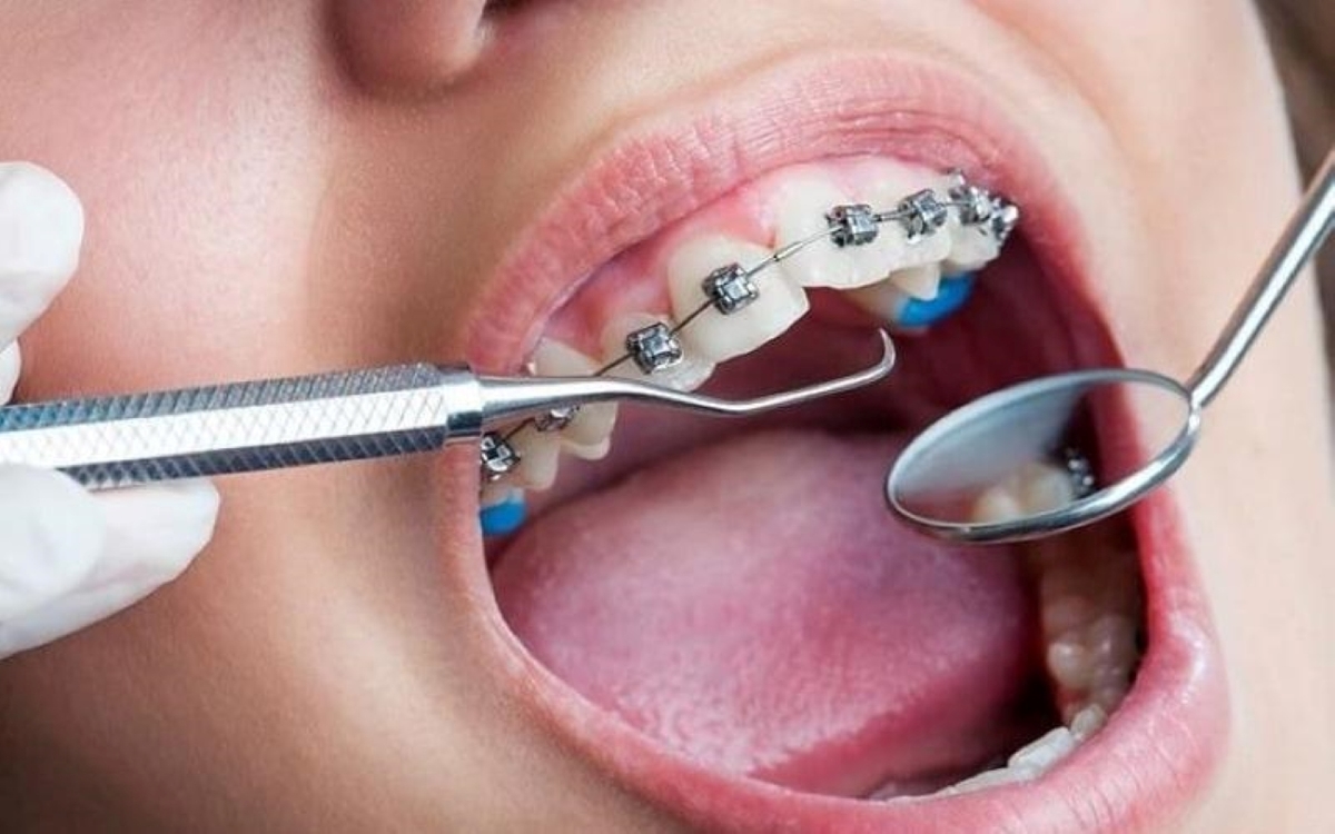 Niềng răng bao lâu thấy được hiệu quả