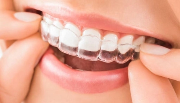 Niềng răng trong suốt