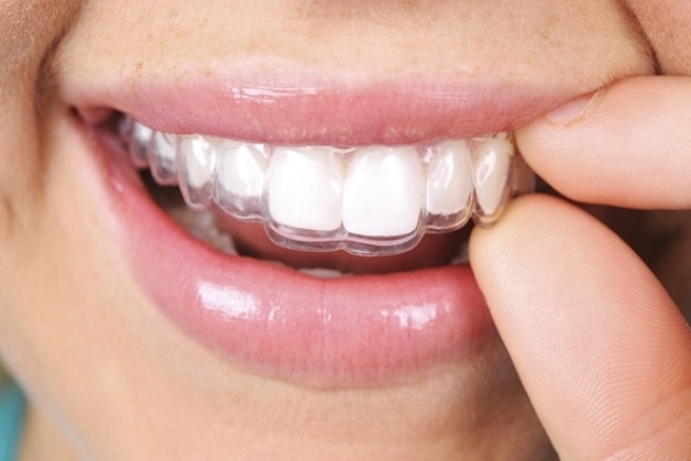 Phương pháp niềng răng thẩm mỹ