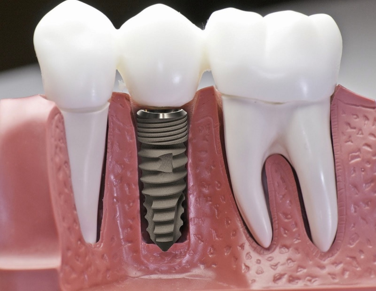 Quá trình cấy ghép implant và những ưu điểm