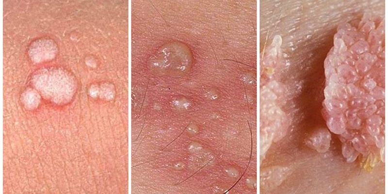 Virus HPV gây các bệnh u nhú, sùi mào gà ở người 