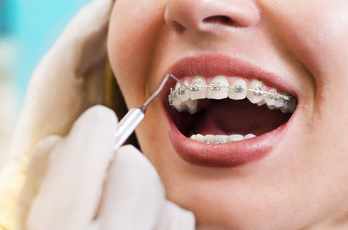 Những lưu ý trước và sau niềng răng