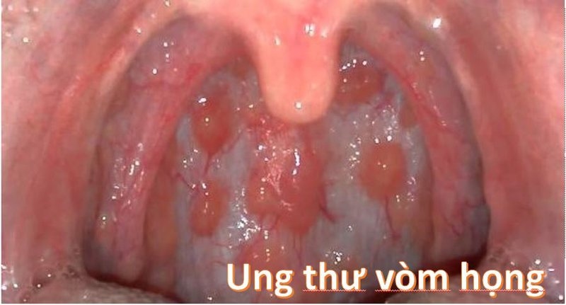 Triệu chứng ung thư vòm họng điển hình cần biết