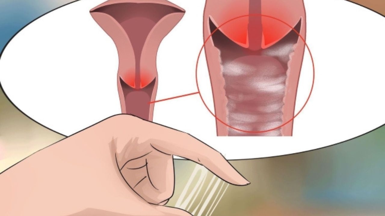 Các dấu hiệu cảnh báo bệnh viêm âm đạo