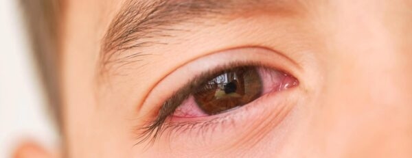 Tìm hiểu về bệnh đau mắt đỏ là gì?