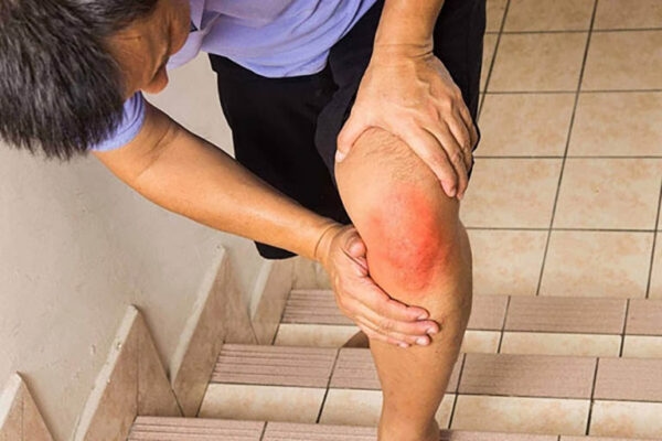Dấu hiệu đứt dây chằng đầu gối