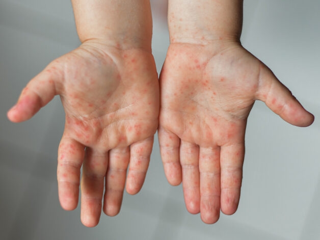 Em bé bị tay chân miệng thường có tổn thương niêm mạc và tổn thương da.