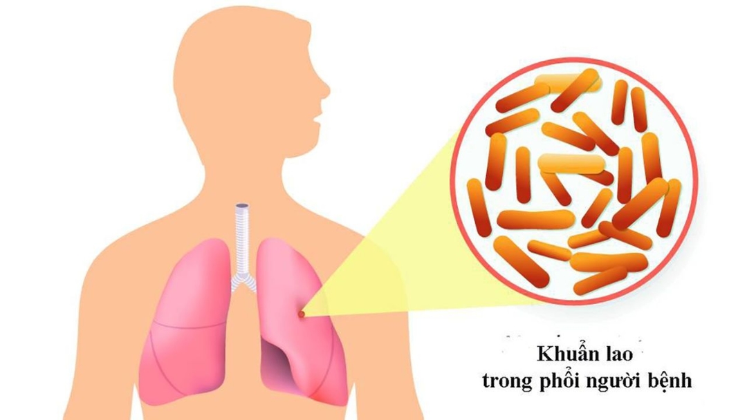 Nguyên nhân gây bệnh lao phổi và cách phòng ngừa hiệu quả