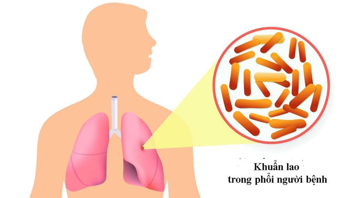Nguyên nhân gây bệnh lao phổi và cách phòng ngừa hiệu quả