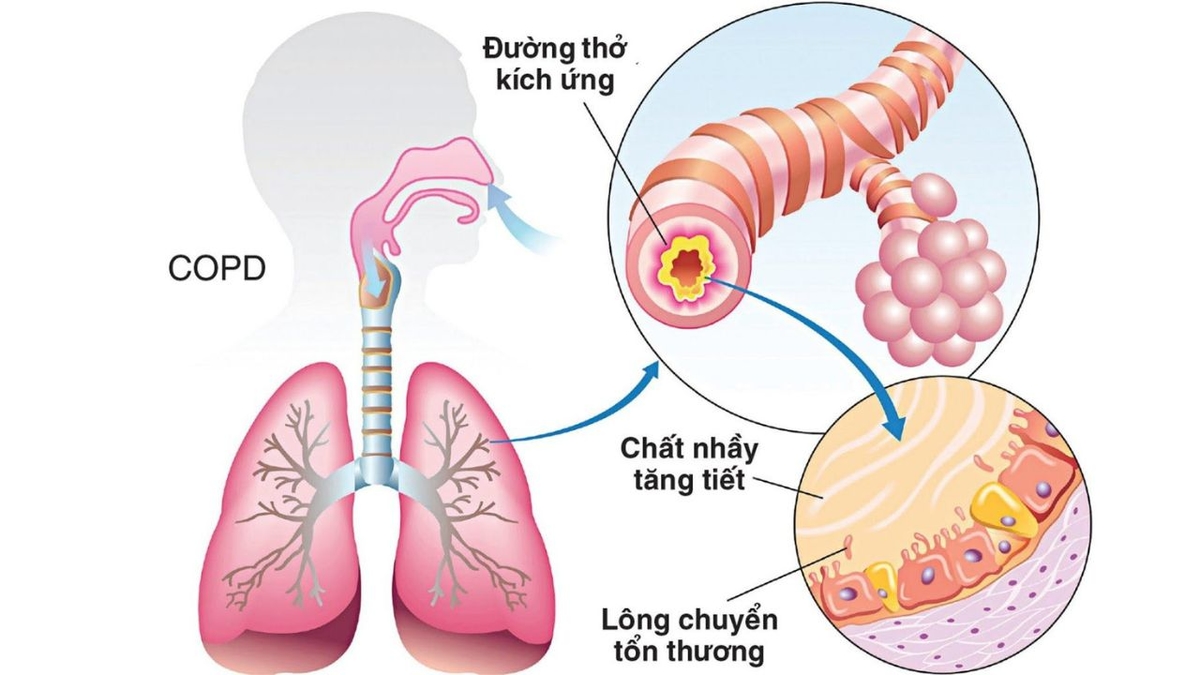 Phổi tắc nghẽn mạn tính: Nguyên nhân, triệu chứng và cách điều trị