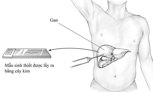 kỹ thuật sinh thiết gan