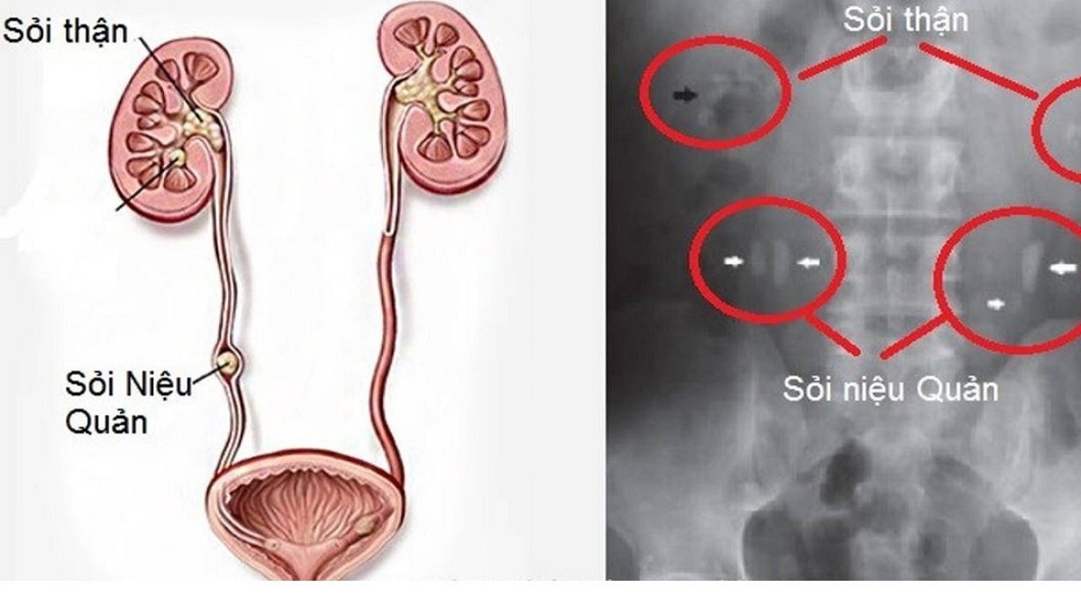 Sỏi niệu quản: Nguyên nhân, triệu chứng và cách điều trị