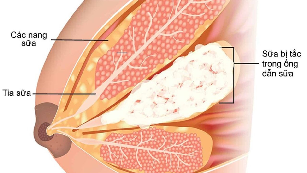 Tắc tia sữa: nguyên nhân và biểu hiện nhận biết