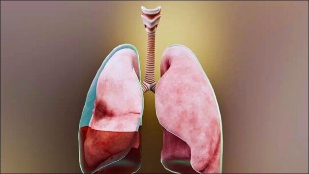 tràn dịch màng phổi tác hại khó lường của bệnh lao phổi