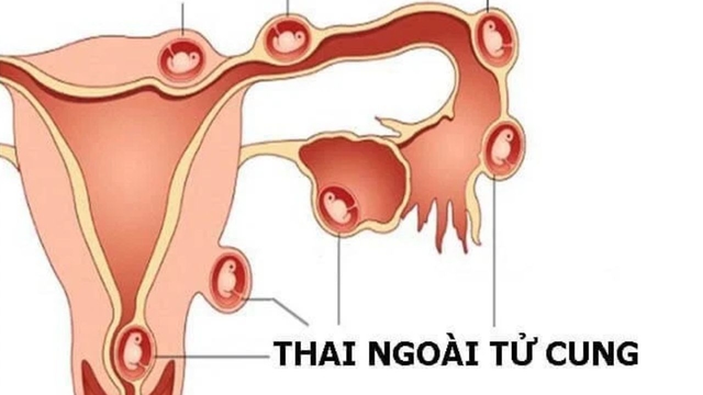 Cảnh báo tỷ lệ thai ngoài tử cung &#8211; Bạn không thể chủ quan!