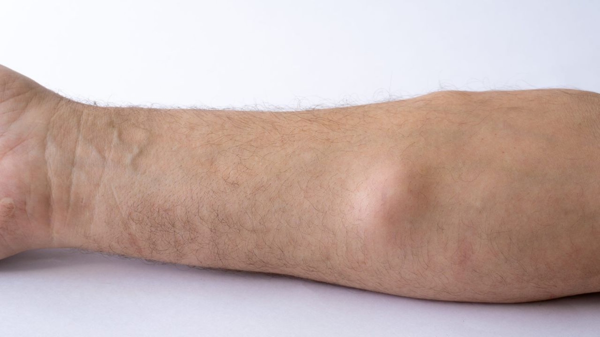 Ung thư mỡ: Những thông tin quan trọng