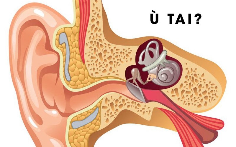 Tình trạng bị ù tai