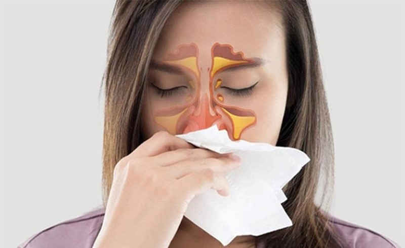 Tìm hiểu cách trị bệnh viêm xoang
