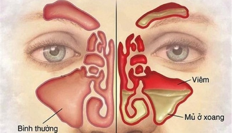 Cách chữa khỏi viêm xoang