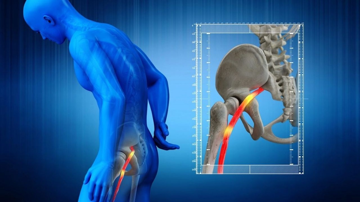 Khám phá và đối phó với cơn đau dây thần kinh tọa ở mông