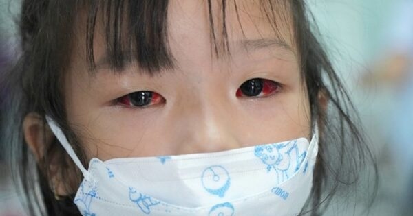 Một số biến chứng có thể gặp khi bị đau mắt đỏ nặng